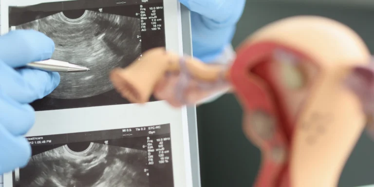 Mapeamento de endometriose: imagens de ultrassom transvaginal analisadas ao lado de modelo anatômico do útero e dos ovários